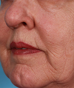 Fractional CO2 Laser Resurfacing Before and After Results in Columbus by Smith Facial Plastics