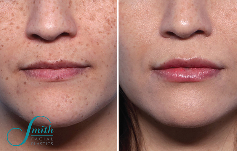 Lip Augmentation Before and After Results in Columbus Ohio by Smith Facial Plastics
