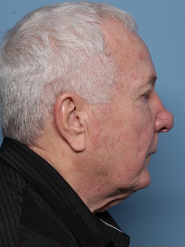 Rhinophyma Excision