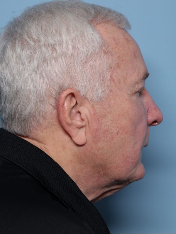 Rhinophyma Excision