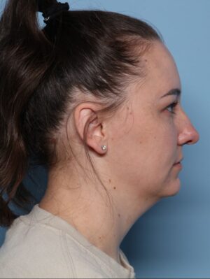 Deep Necklift