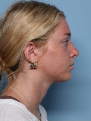 Rhinoplasty