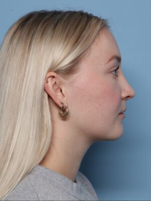 Rhinoplasty