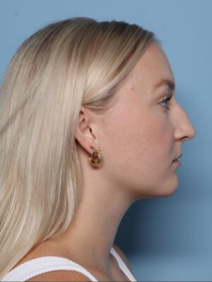 Rhinoplasty