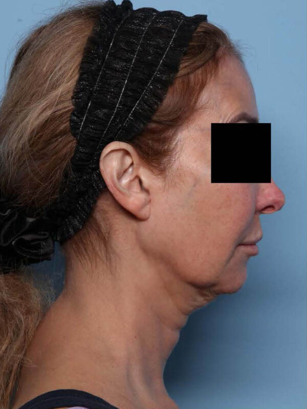 Deep Necklift