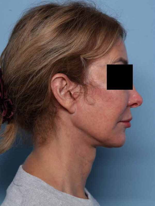 Deep Necklift