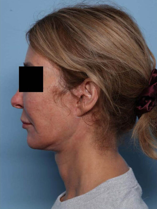 Deep Necklift