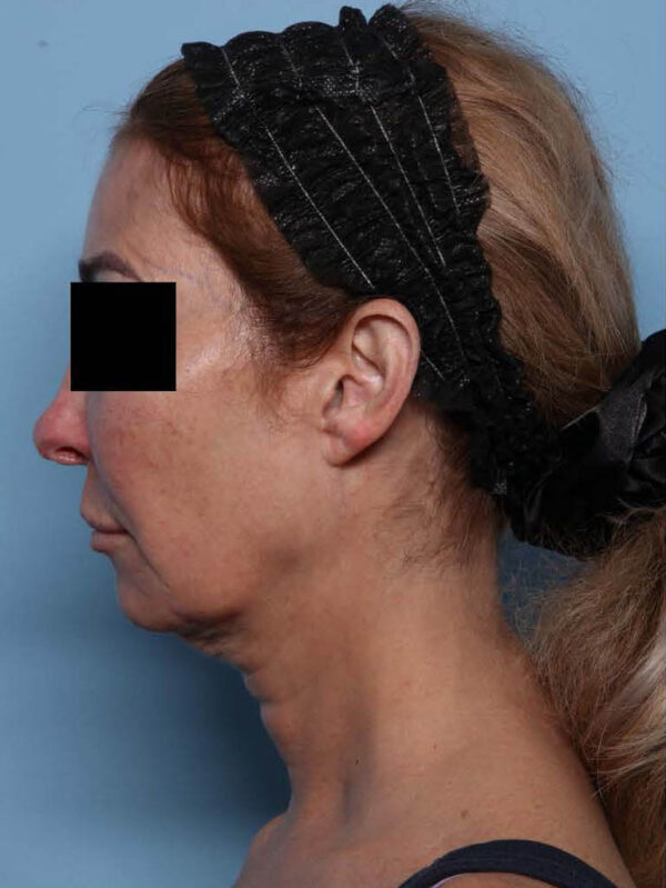 Deep Necklift